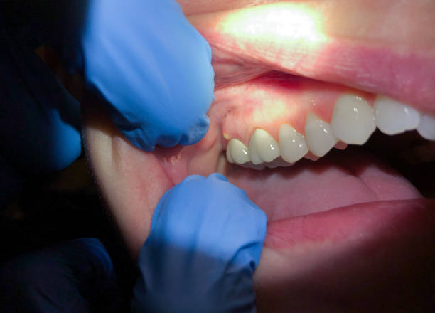 Best Emergency Dentist for Lost Fillings or Crowns in Greenfield, TN